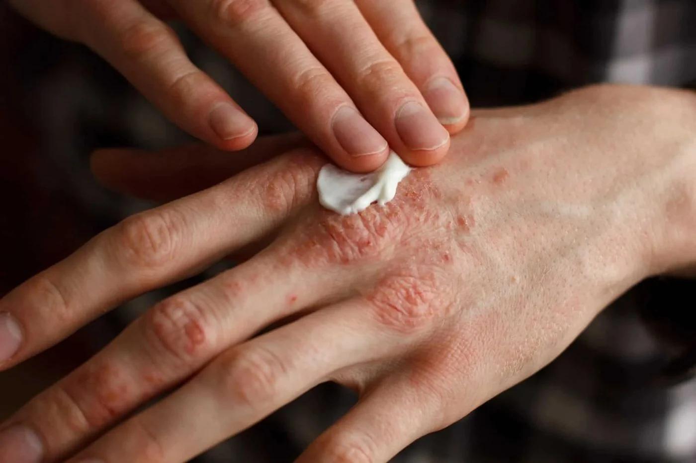 Psoriasis: por qué menos lesiones no significa enfermedad leve